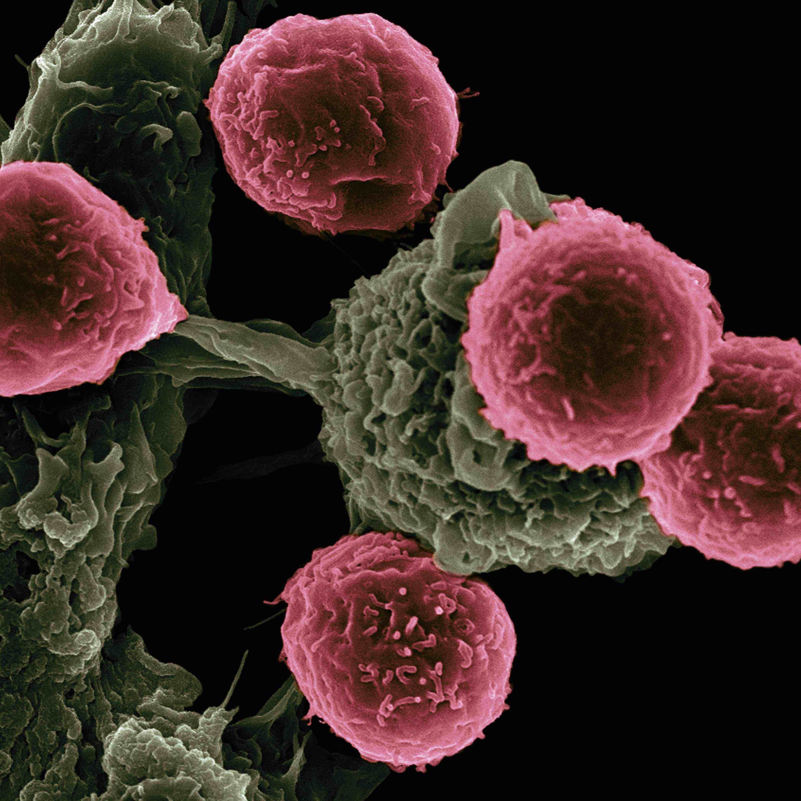 I numeri del cancro. Pubblicata la relazione annuale sui tumori dell’Aiom. Quasi 20 mila casi in più in 3 anni