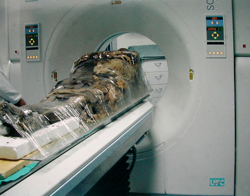 Cangrande fu vittima di Glicogenosi tipo II  e non di avvelenamento: la conferma dalla prima analisi genetica su una mummia