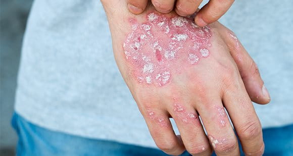 La psoriasi colpisce più di un milione di italiani ma non è riconosciuta come malattia 