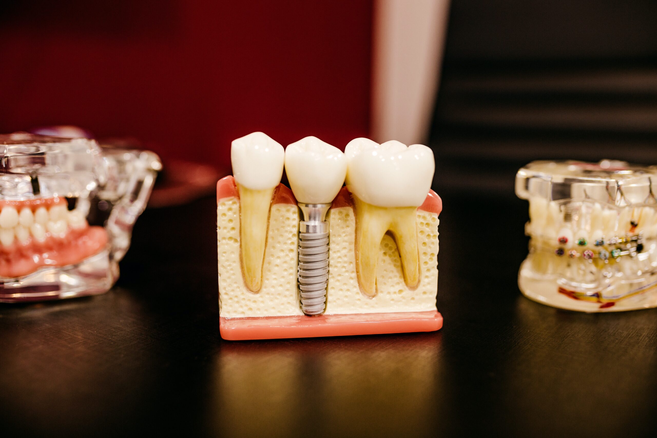15 milioni di italiani hanno in bocca impianti dentali. Ma per farli durare è necessaria un’igiene accuratissima