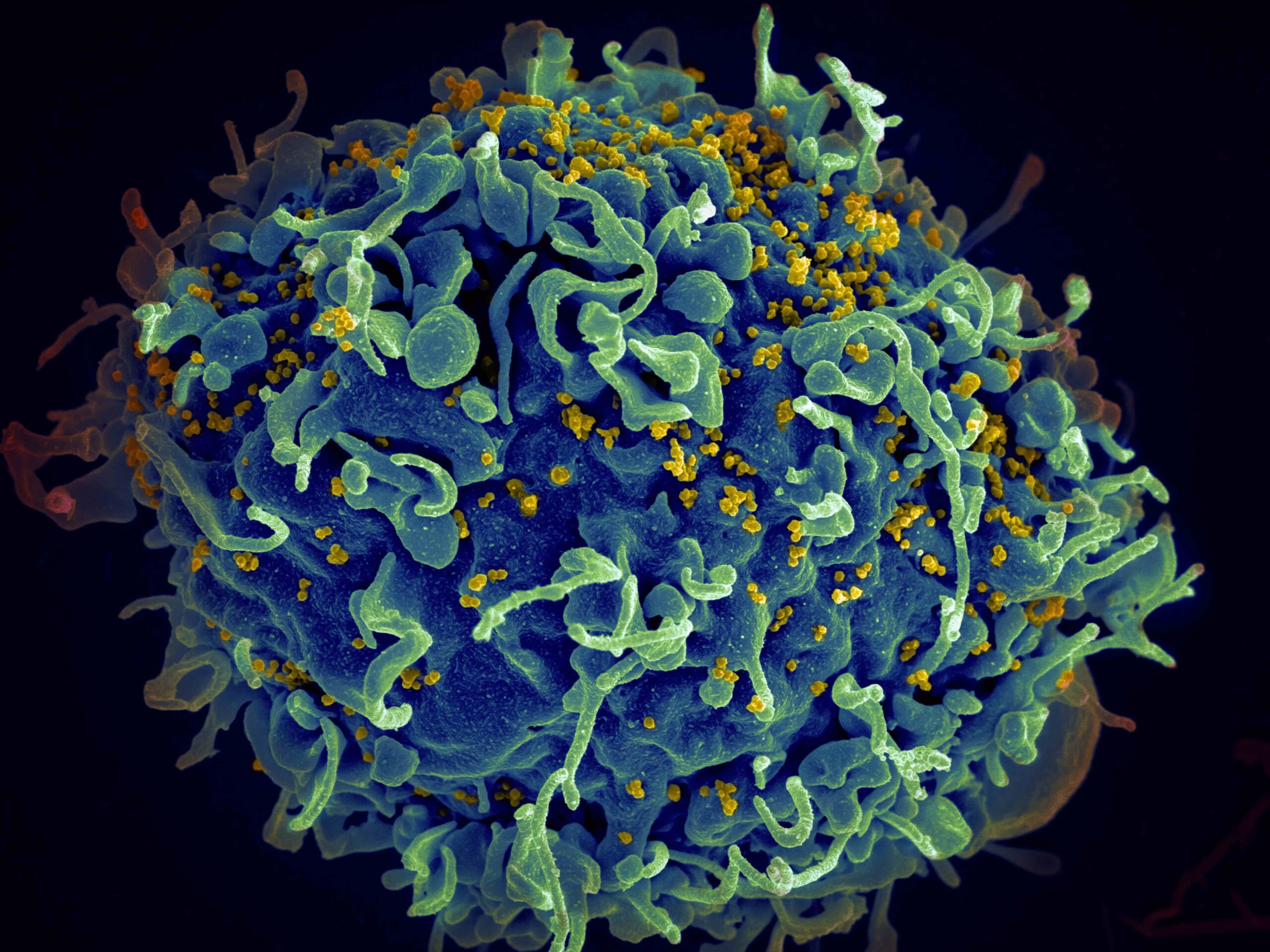 Aids. Il 40% scopre di averlo per caso 1 Aids. Il 40% scopre di averlo per caso