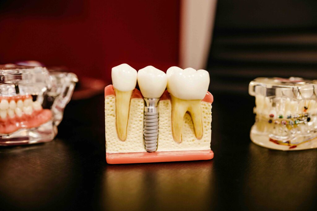 Nel 2024 in Italia eseguiti 2 milioni di impianti dentali 1 Nel 2024 in Italia eseguiti 2 milioni di impianti dentali