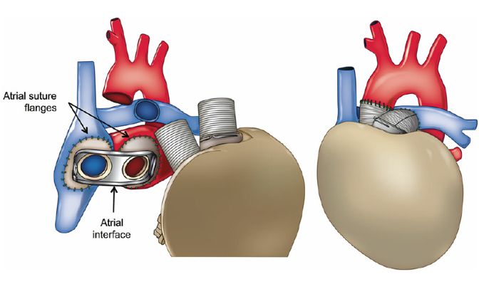 cuore artificiale