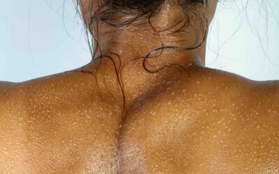 Mappatura dei nei. Non è più a carico del Ssn per decisione nazionale 