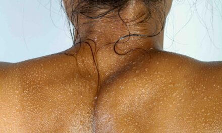 Estate, vacanze, sole ma attenzione al melanoma