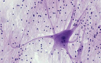 SLA. 20 nuovi casi all’anno in provincia di Verona