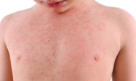 Un italiano su 10 può prendere il morbillo