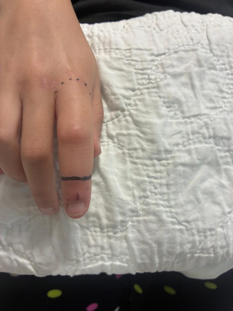 Centro Antiveleni, il più precoce morso di vipera degli ultimi anni 1 Il morso sulla mano della bambina