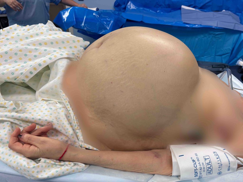 Intervento eccezionale a Borgo Trento: rimossa cisti ovarica di 50 kg 1 La cisti ovarica prima dellintervento