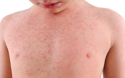 Il Morbillo torna a circolare perché non vengono rispettate le vaccinazioni